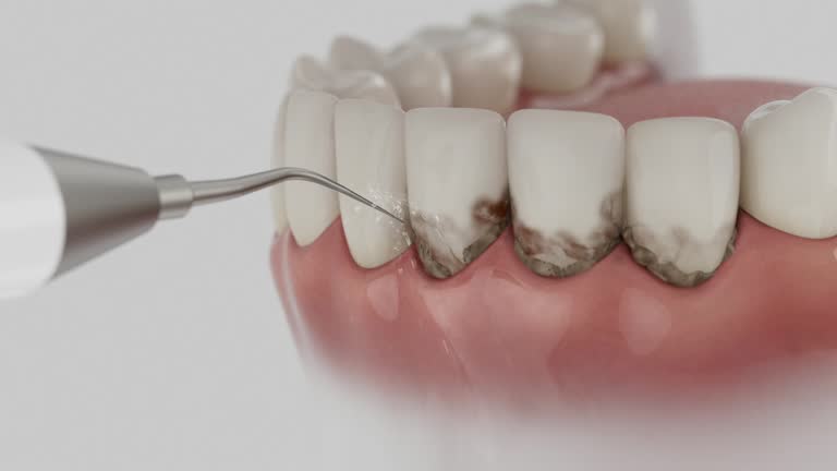 Trusted Dental Implants service in Hanover, OH - Dentist Open Now